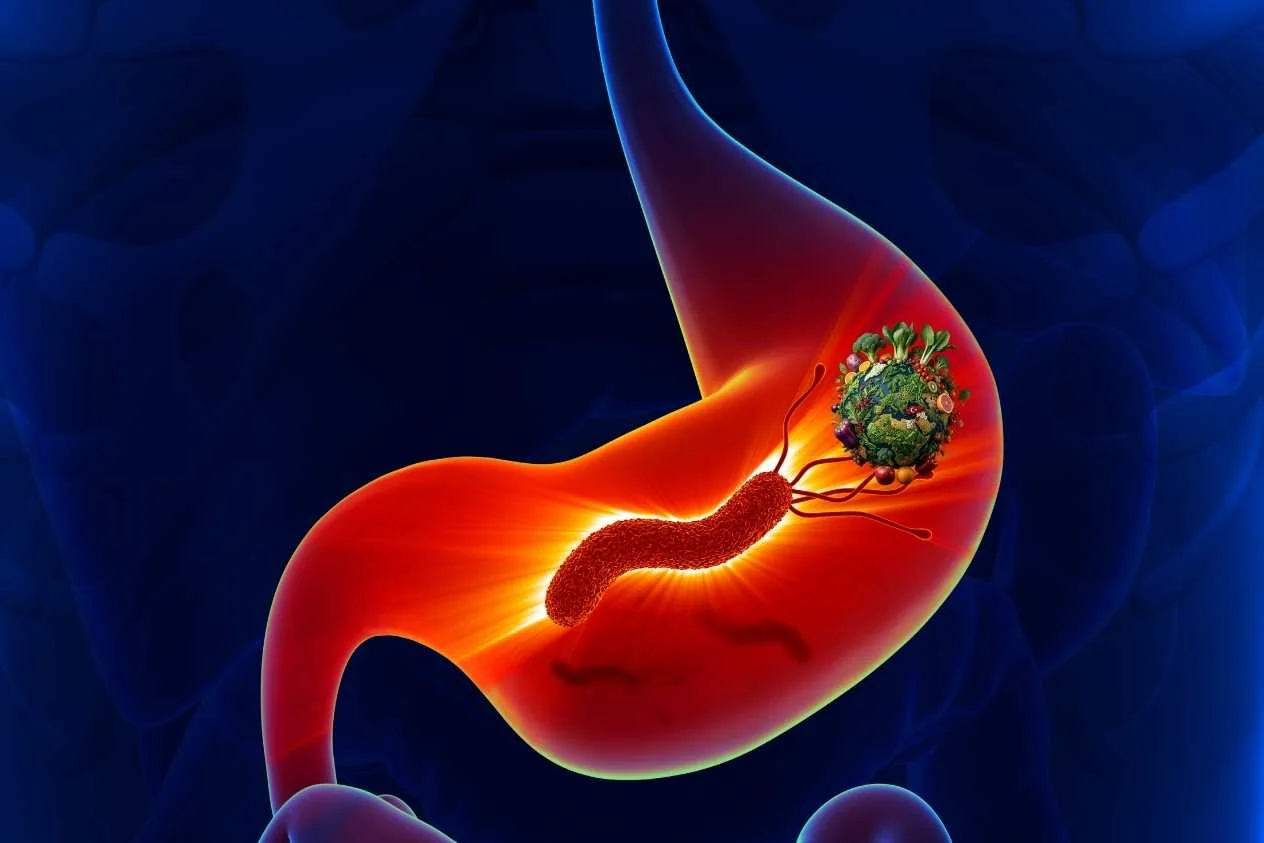 Helicobacter Pylori (Mide Mikrobu) Hastaları Ne Yememeli? Beslenme Rehberi